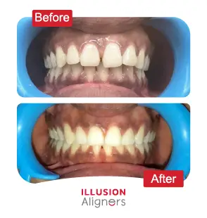 Illusion Aligners